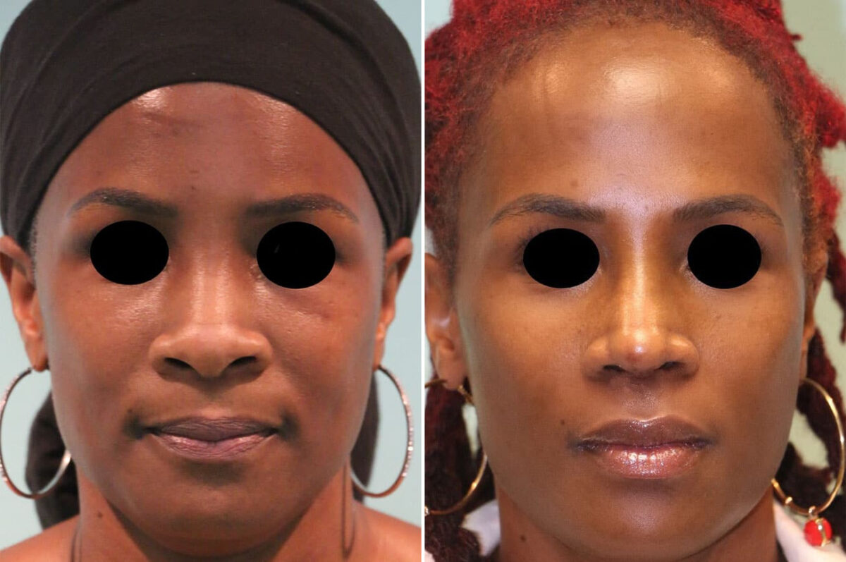 Before and after Rhinoplasty by Dr. Shervin Naderi, Patient 14408