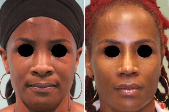 Before and after Rhinoplasty by Dr. Shervin Naderi, Patient 14408