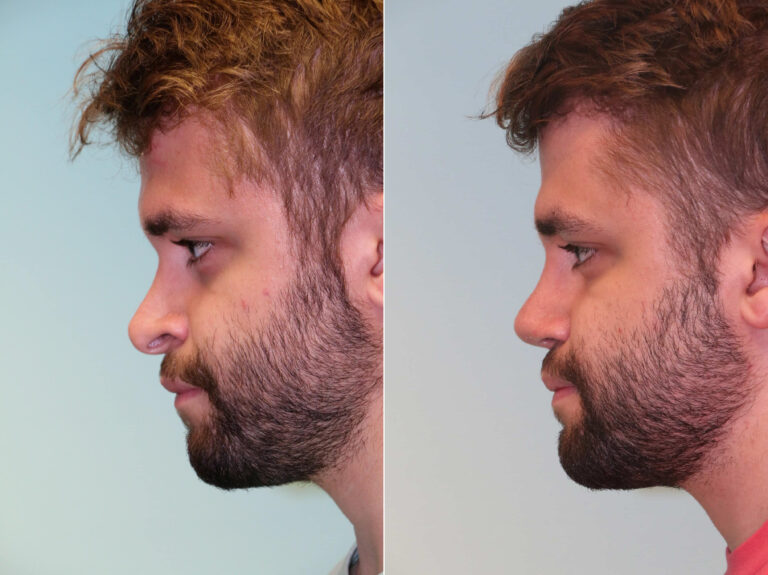 Before and after revision rhinoplasty by Dr. Shervin Naderi: an over-reduced nose