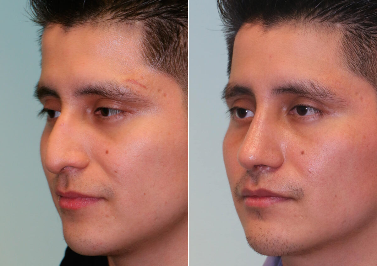Before and after Rhinoplasty by Dr. Shervin Naderi, Patient 14752
