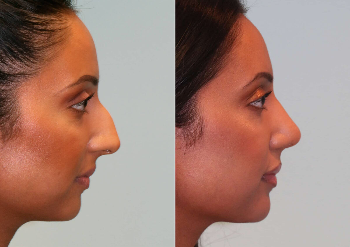 Before and after Rhinoplasty by Dr. Shervin Naderi, Patient 14769