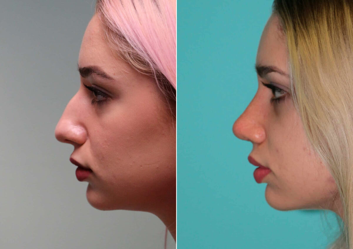 Before and after Rhinoplasty by Dr. Shervin Naderi, Patient 14867