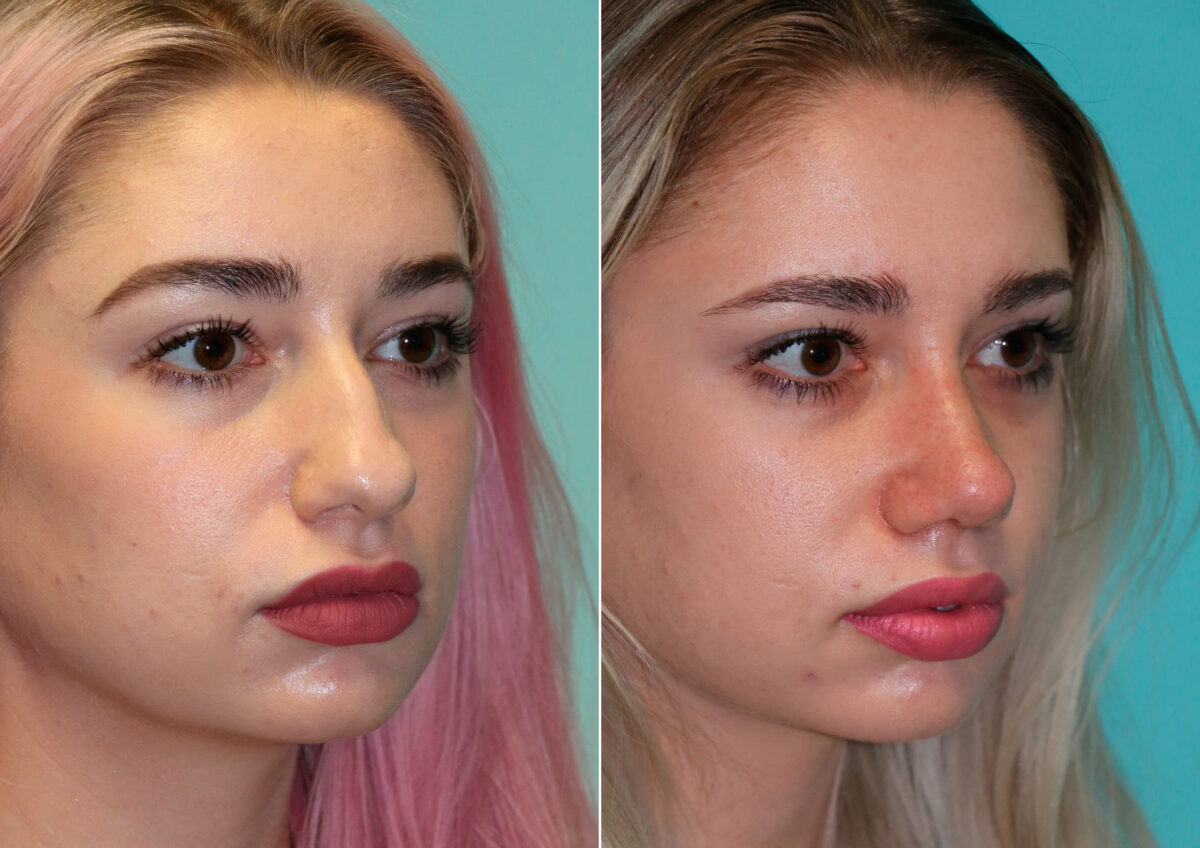 Before and after Rhinoplasty by Dr. Shervin Naderi, Patient 14867