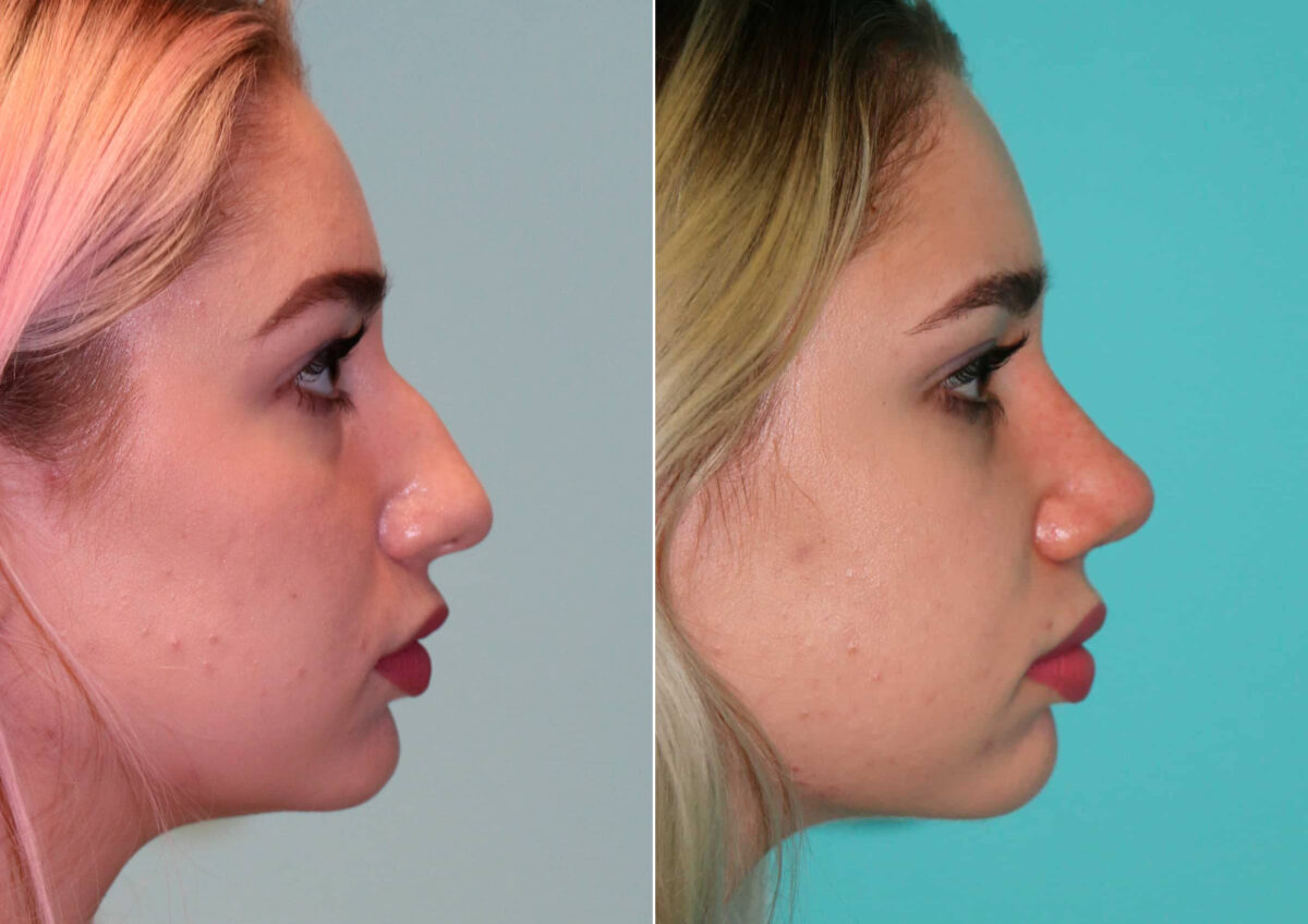 Before and after Rhinoplasty by Dr. Shervin Naderi, Patient 14867