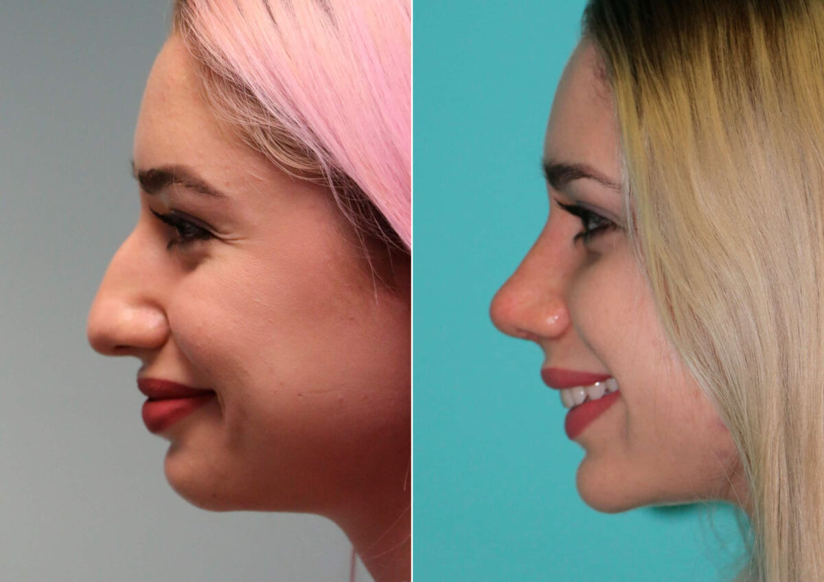 Before and after Rhinoplasty by Dr. Shervin Naderi, Patient 14867