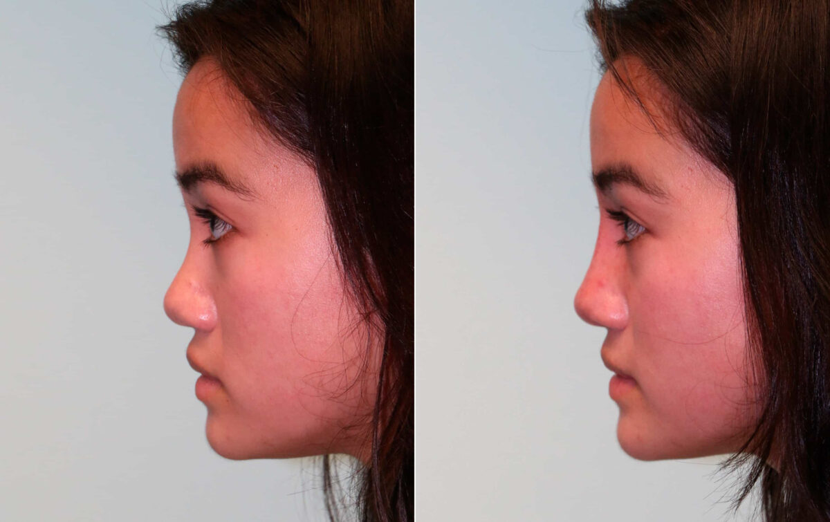 Before and after Non-Surgical Rhinoplasty by Dr. Shervin Naderi, Patient 15288