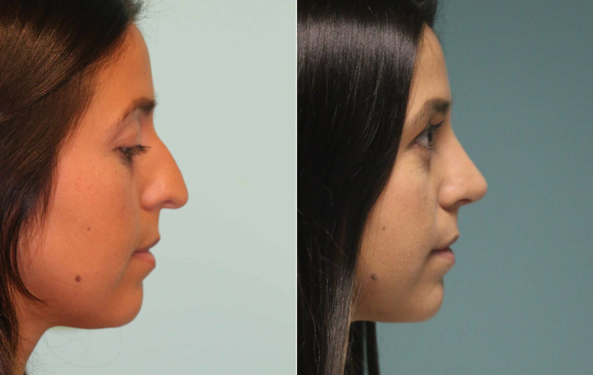 Before and after Rhinoplasty by Dr. Shervin Naderi, Patient 15301