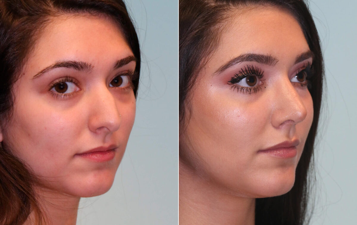 Before and after Rhinoplasty by Dr. Shervin Naderi, Patient 15325