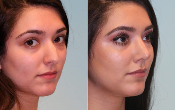 Before and after Rhinoplasty by Dr. Shervin Naderi, Patient 15325