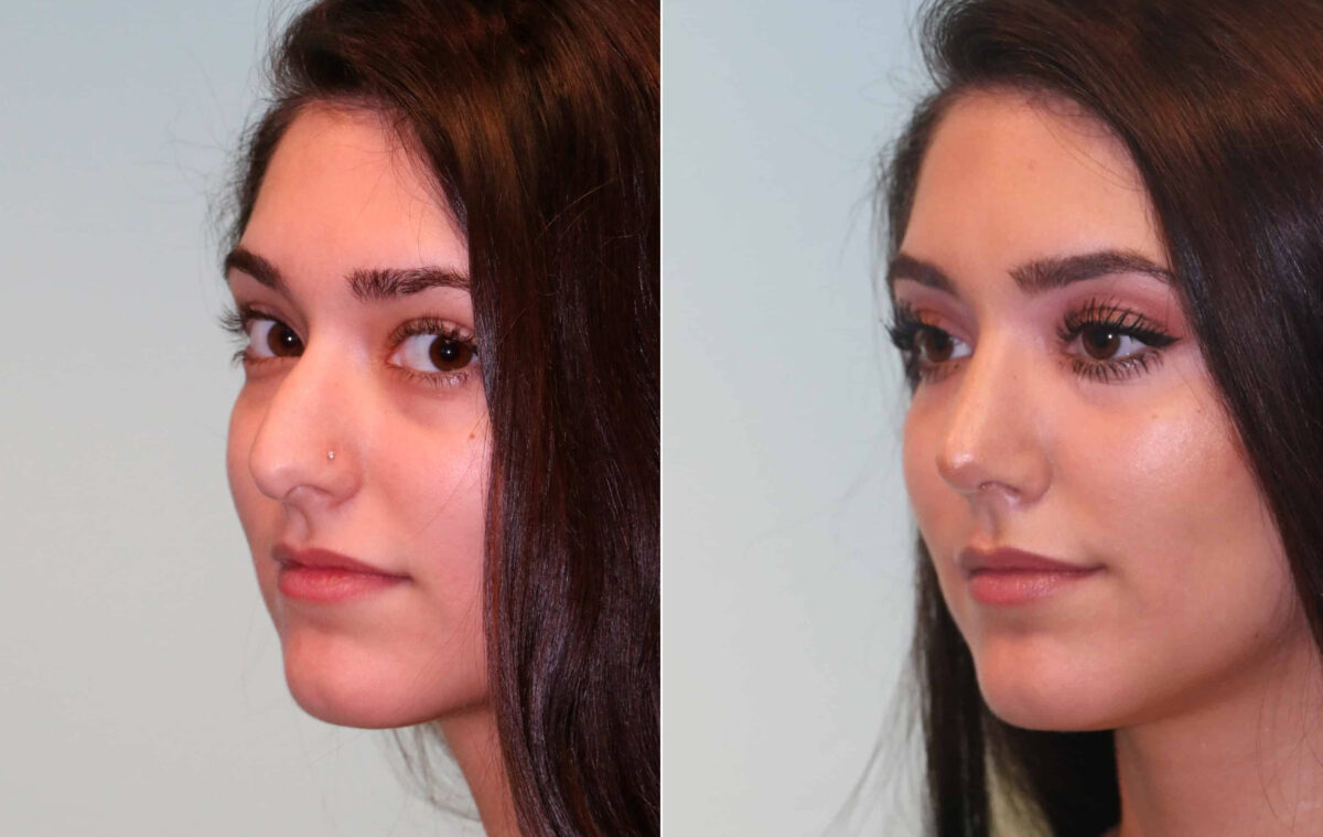 Before and after Rhinoplasty by Dr. Shervin Naderi, Patient 15325