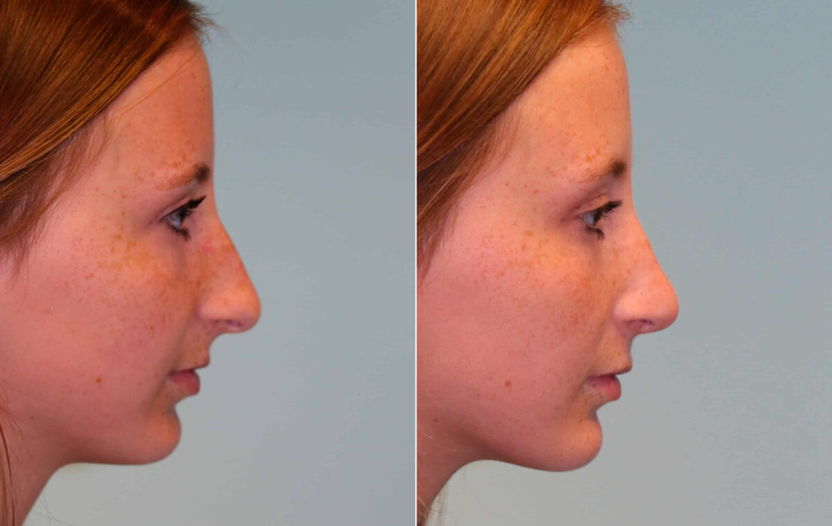 Before and after Revision Rhinoplasty by Dr. Shervin Naderi, Patient 15344