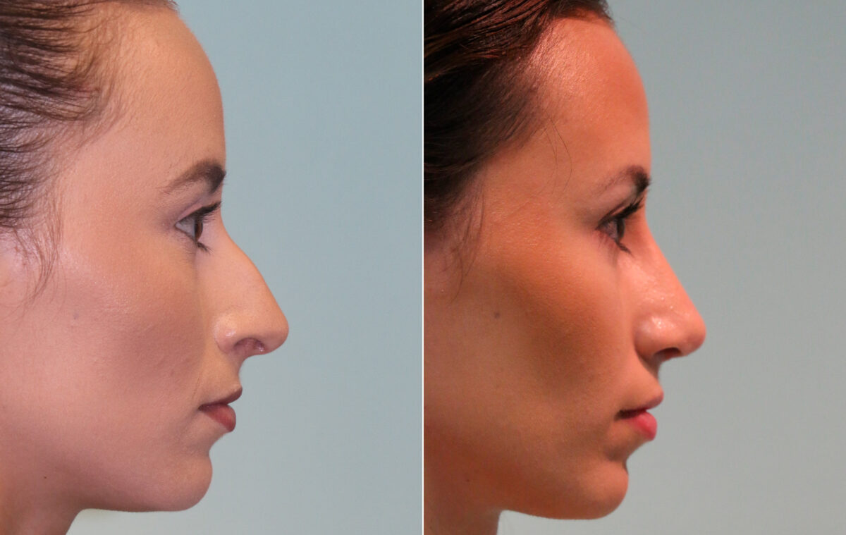 Before and after Rhinoplasty by Dr. Shervin Naderi, Patient 15657
