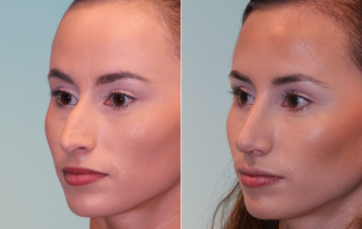 Before and after Rhinoplasty by Dr. Shervin Naderi, Patient 15657