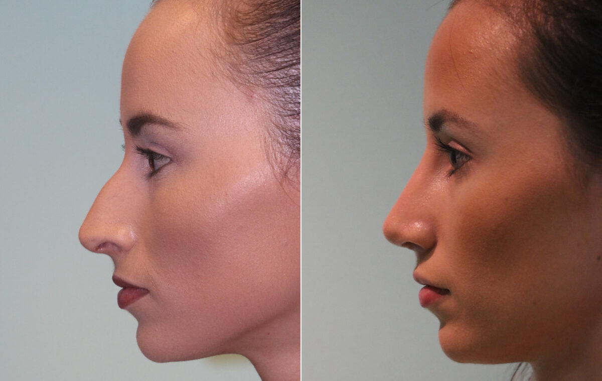 Before and after Rhinoplasty by Dr. Shervin Naderi, Patient 15657