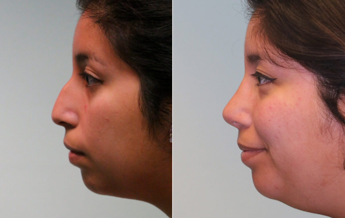 Before and after Rhinoplasty by Dr. Shervin Naderi, Patient 15674