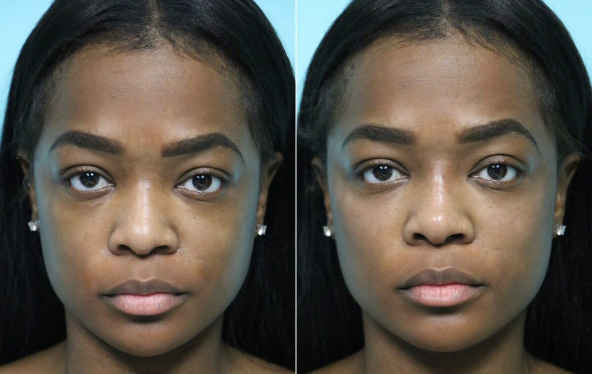 Before and after Non-Surgical Rhinoplasty by Dr. Shervin Naderi, Patient 15755