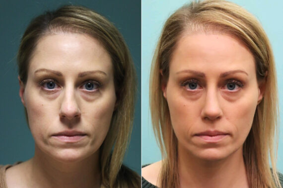 Before and after Rhinoplasty by Dr. Shervin Naderi, Patient 16395
