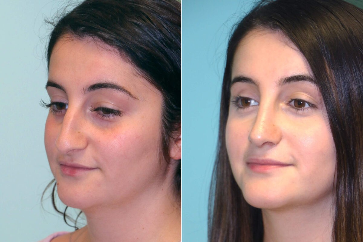 Before and after Rhinoplasty by Dr. Shervin Naderi, Patient 16427
