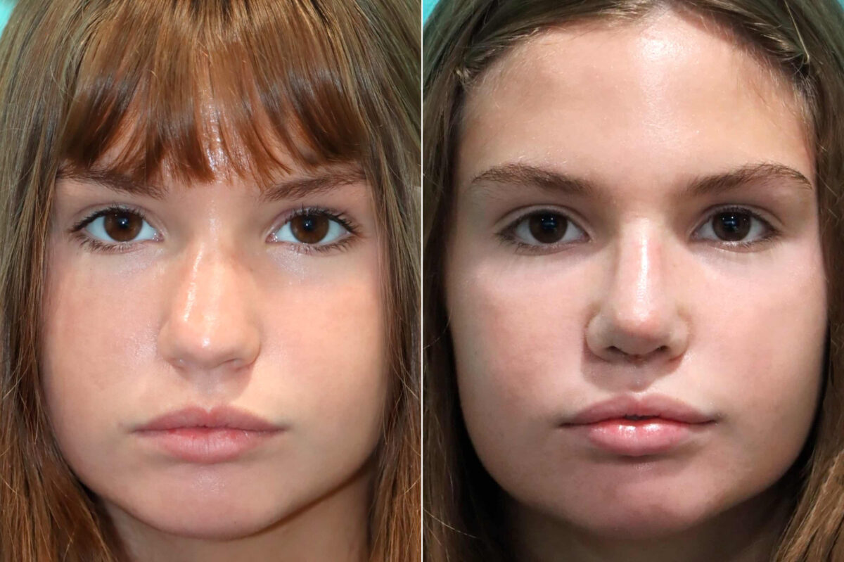 Before and after Rhinoplasty by Dr. Shervin Naderi, Patient 17630