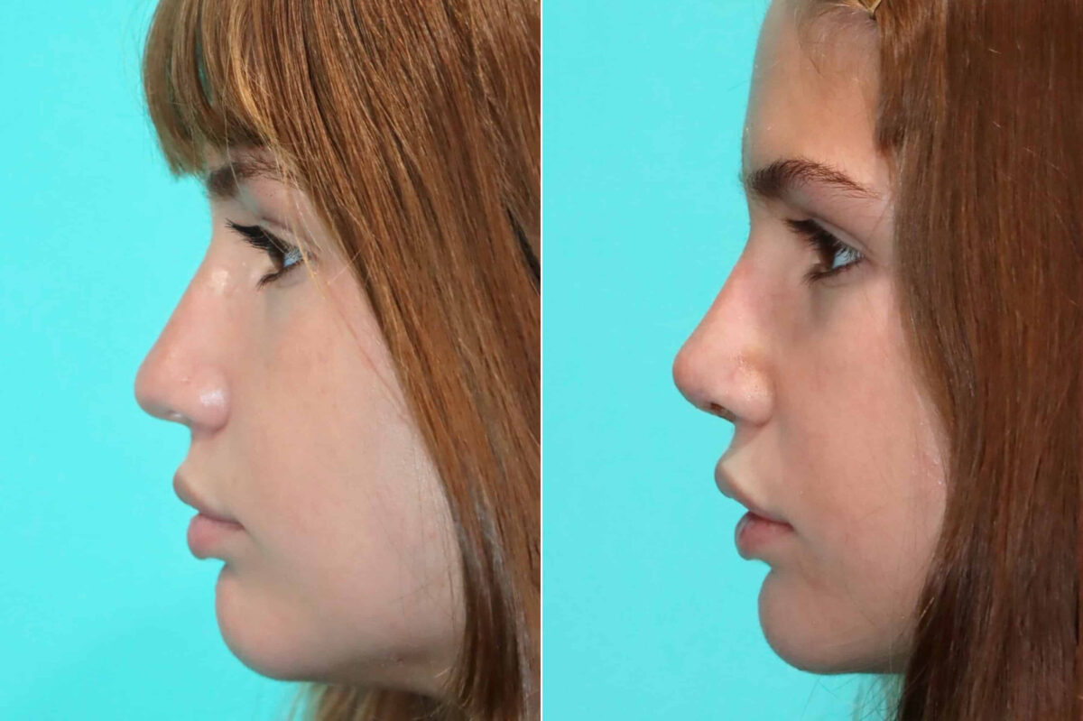 Before and after Rhinoplasty by Dr. Shervin Naderi, Patient 17630