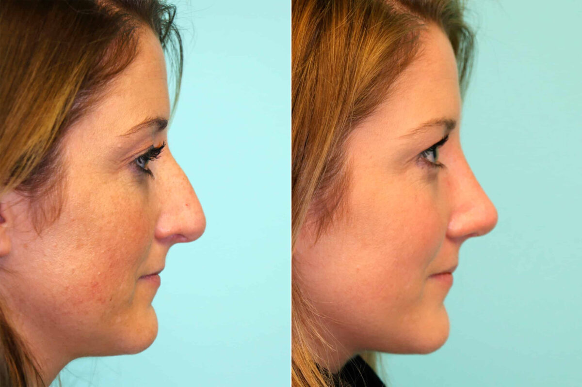 Before and after Rhinoplasty by Dr. Shervin Naderi, Patient 17660