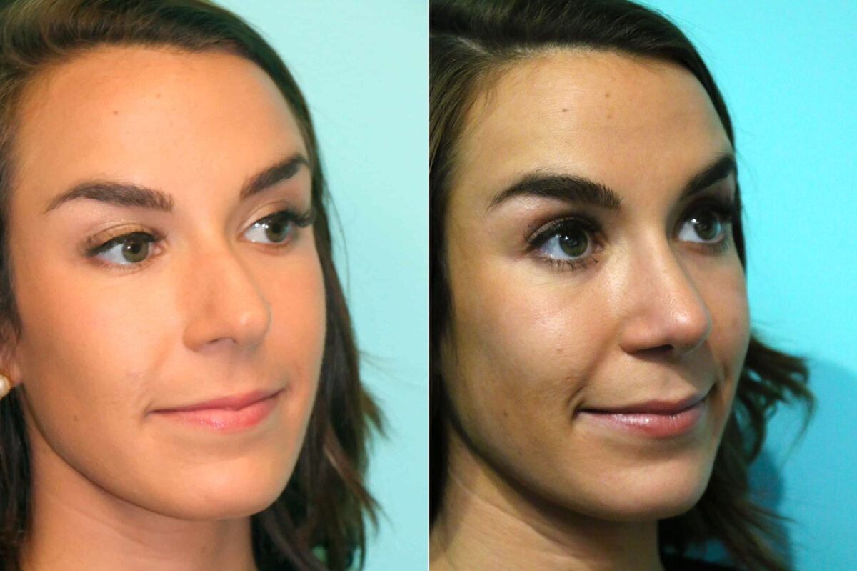 Before and after Rhinoplasty by Dr. Shervin Naderi, Patient 17902