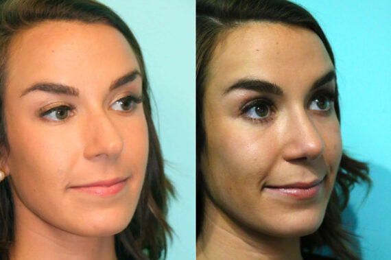 Before and after Rhinoplasty by Dr. Shervin Naderi, Patient 17902