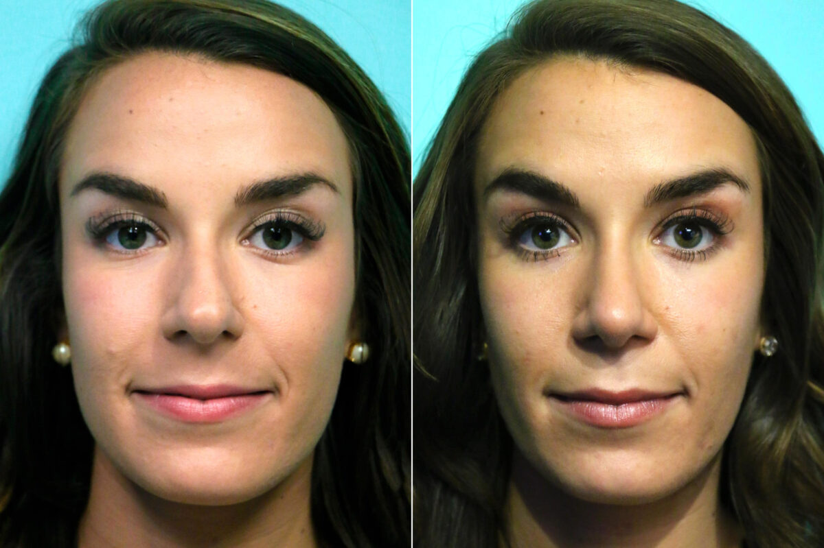 Before and after Rhinoplasty by Dr. Shervin Naderi, Patient 17902