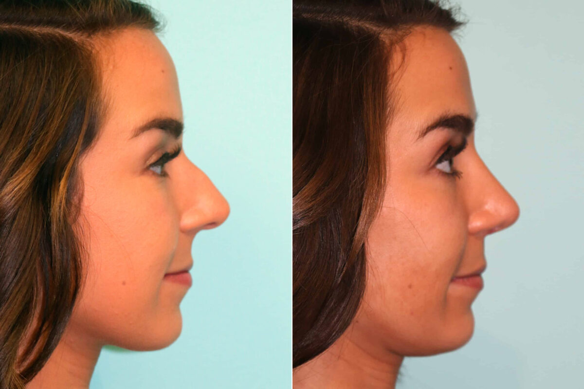 Before and after Rhinoplasty by Dr. Shervin Naderi, Patient 17902