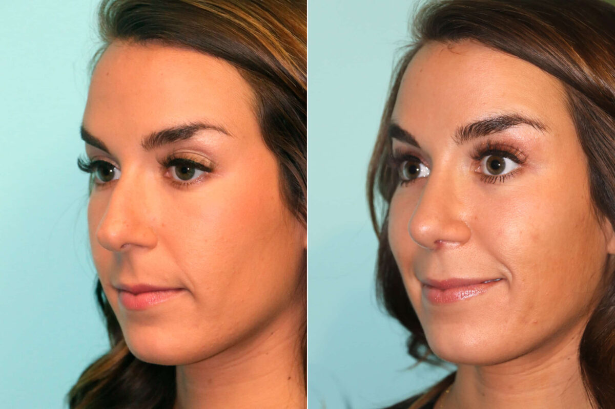Before and after Rhinoplasty by Dr. Shervin Naderi, Patient 17902