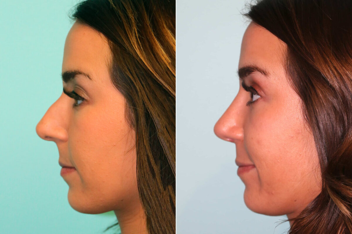 Before and after Rhinoplasty by Dr. Shervin Naderi, Patient 17902