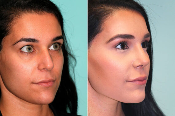 Before and after Rhinoplasty by Dr. Shervin Naderi, Patient 17954