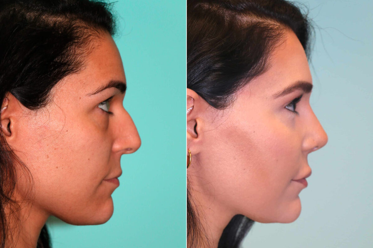Before and after Rhinoplasty by Dr. Shervin Naderi, Patient 17954