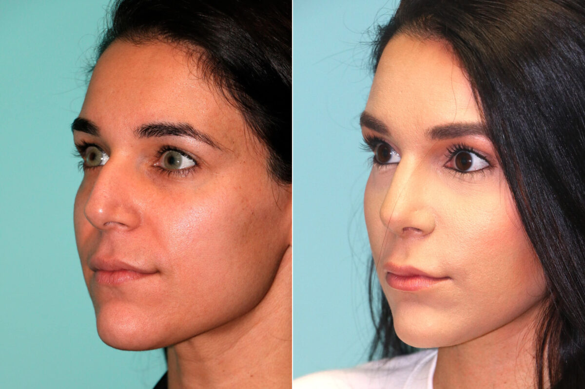 Before and after Rhinoplasty by Dr. Shervin Naderi, Patient 17954