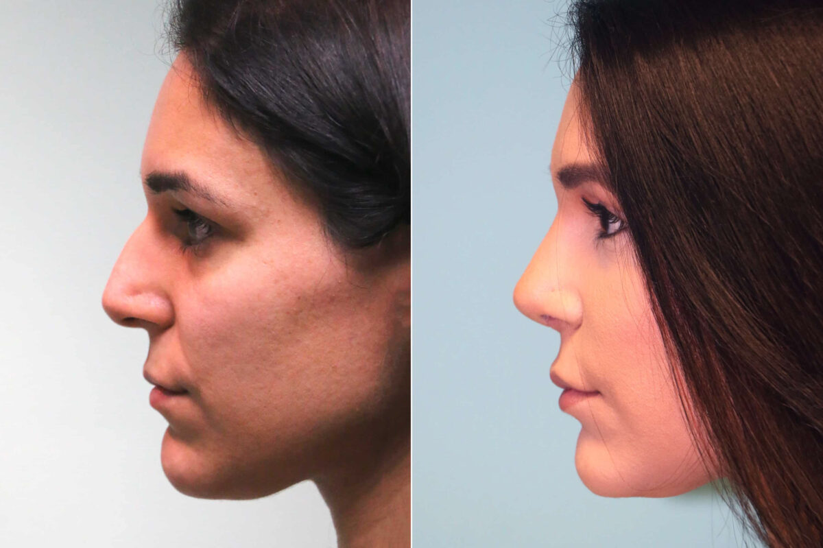 Before and after Rhinoplasty by Dr. Shervin Naderi, Patient 17954