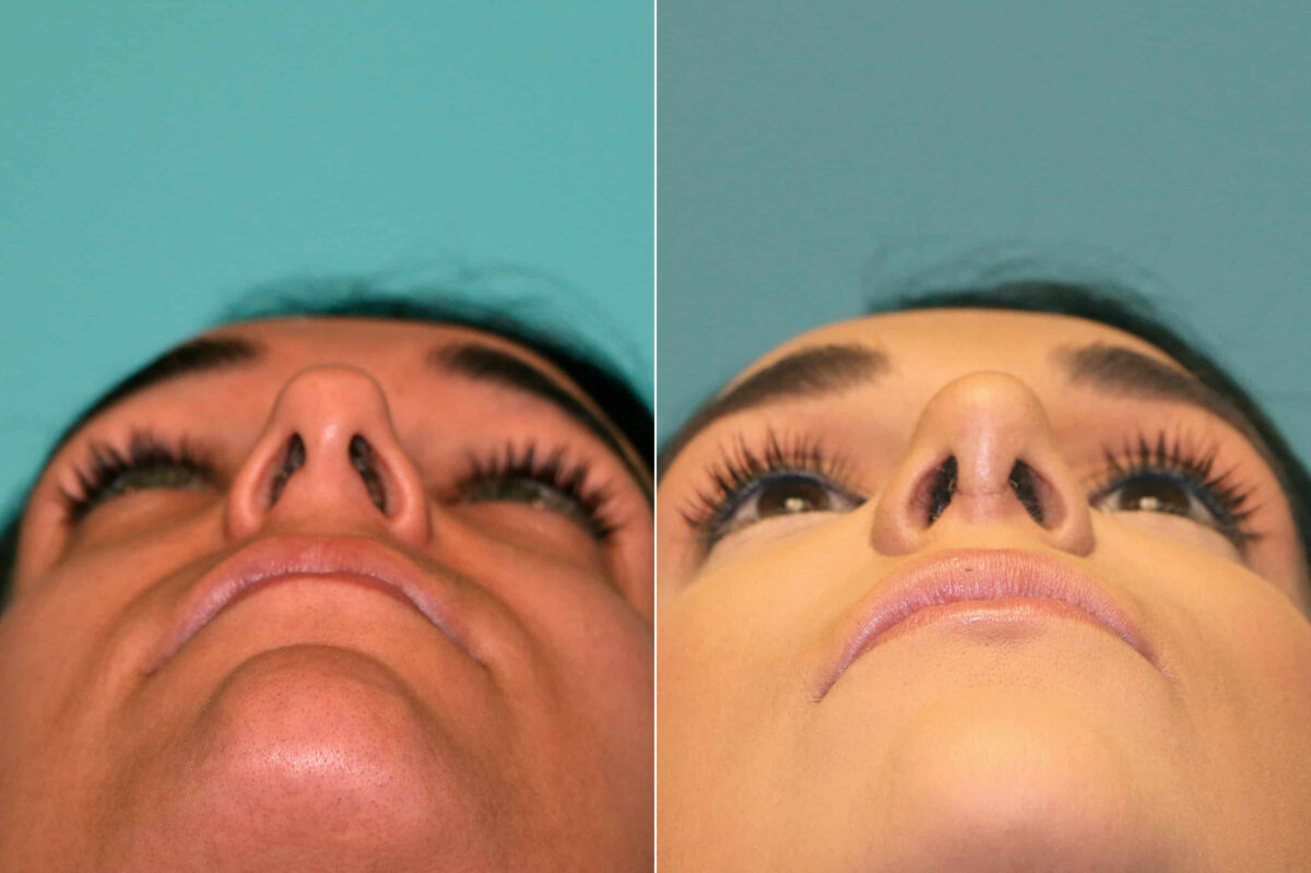 Before and after Rhinoplasty by Dr. Shervin Naderi, Patient 17954
