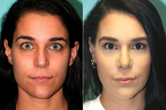 Before and after Rhinoplasty by Dr. Shervin Naderi, Patient 17954