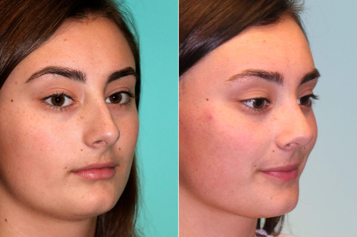 Before and after Rhinoplasty by Dr. Shervin Naderi, Patient 17973