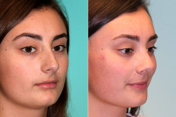 Before and after Rhinoplasty by Dr. Shervin Naderi, Patient 17973