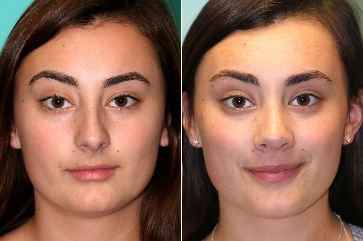 Before and after Rhinoplasty by Dr. Shervin Naderi, Patient 17973