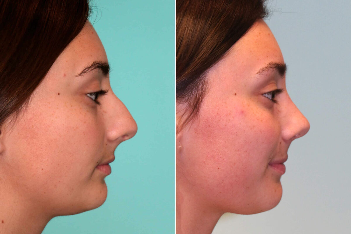 Before and after Rhinoplasty by Dr. Shervin Naderi, Patient 17973