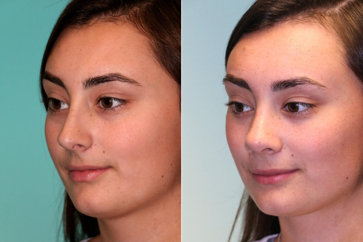 Before and after Rhinoplasty by Dr. Shervin Naderi, Patient 17973