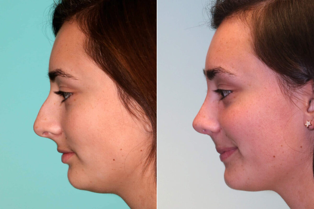 Before and after Rhinoplasty by Dr. Shervin Naderi, Patient 17973