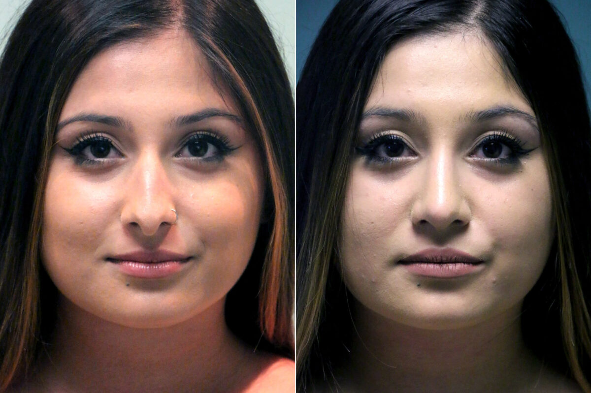 Before and after Rhinoplasty by Dr. Shervin Naderi, Patient 18030