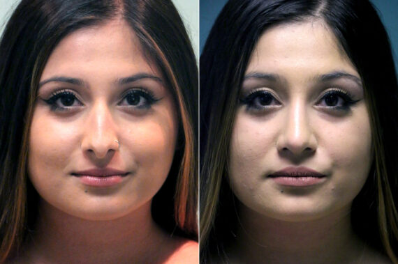 Before and after Rhinoplasty by Dr. Shervin Naderi, Patient 18030
