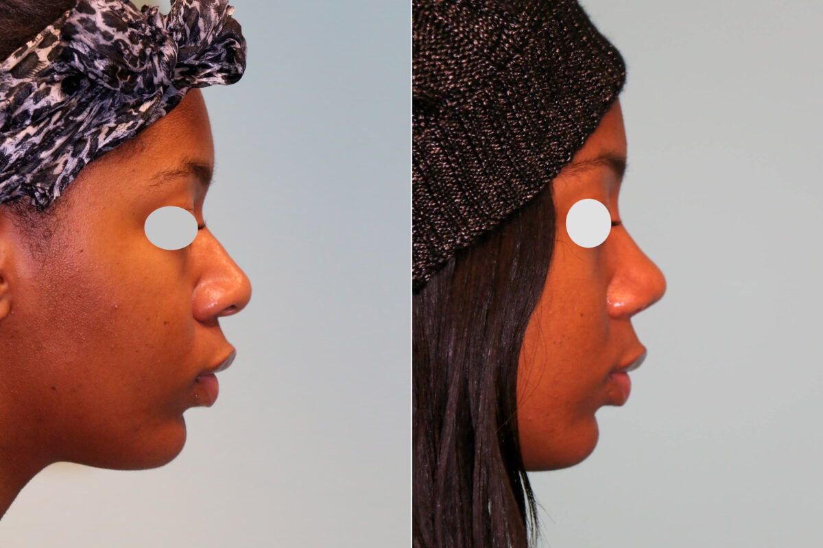 Before and after Rhinoplasty by Dr. Shervin Naderi, Patient 18892