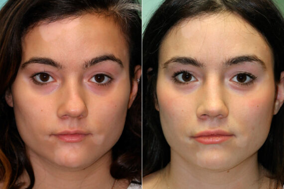 Before and after Rhinoplasty by Dr. Shervin Naderi, Patient 19061