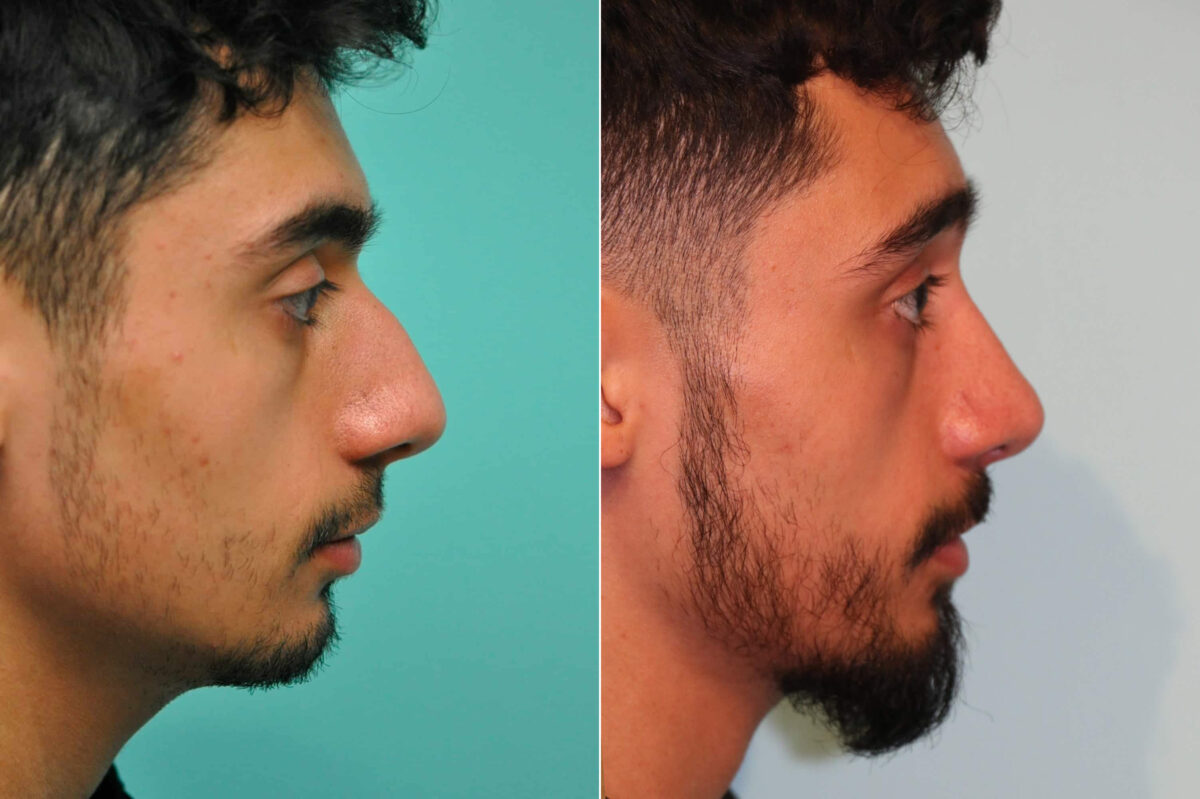 Before and after Rhinoplasty by Dr. Shervin Naderi, Patient 19132