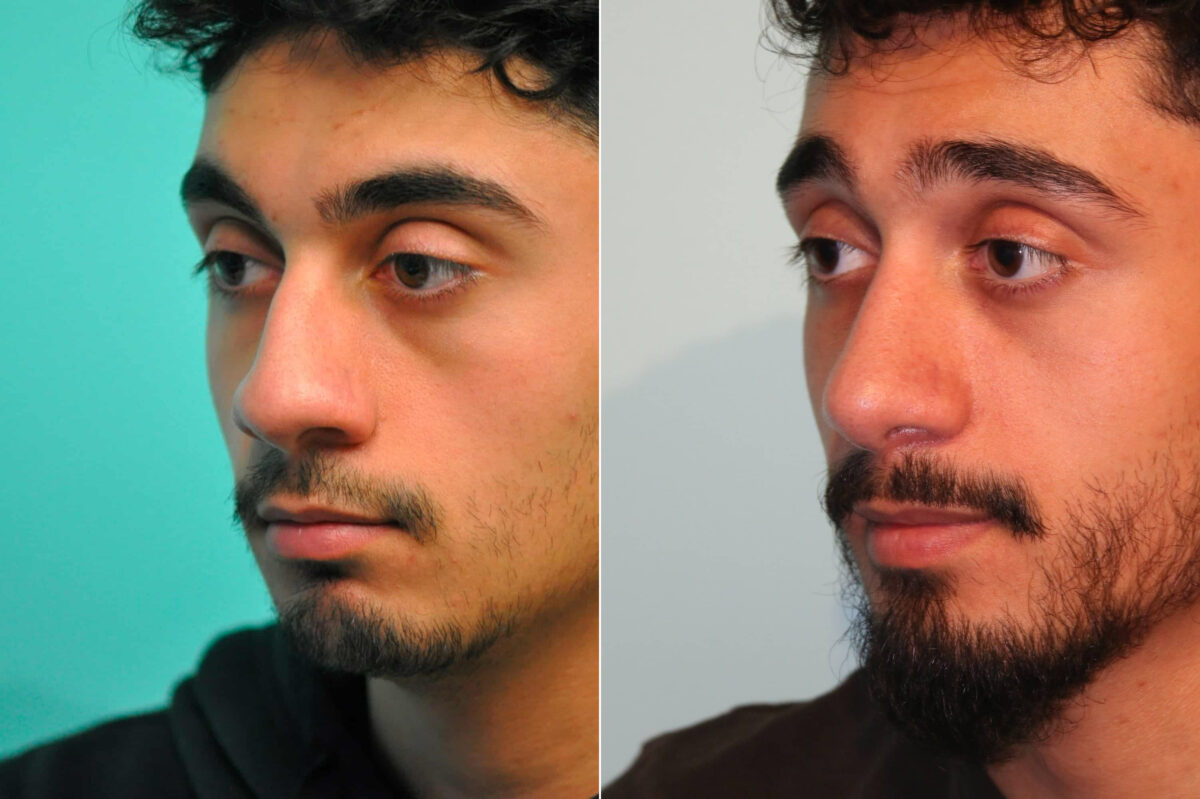 Before and after Rhinoplasty by Dr. Shervin Naderi, Patient 19132