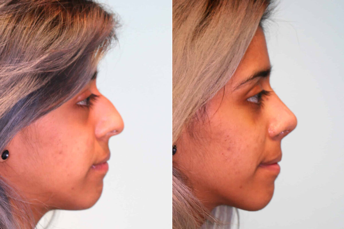 Before and after Rhinoplasty by Dr. Shervin Naderi, Patient 19199
